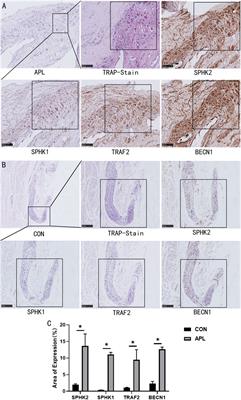 SPHK Inhibitors and Zoledronic Acid Suppress Osteoclastogenesis and Wear Particle-Induced Osteolysis